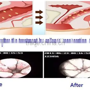 100um-2000um CO2 Fractional Laser Scar Removal Skin Resurfacing Fractional Co2 Laser Equipment Eye Wrinkle / Bag Removal thumbnail-3