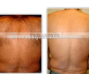 Portable Ipl Laser Hair Removal Machine thumbnail-6