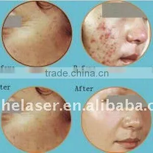 Best Selling Products !!co2 Fractional Clinic Co2 Fractional Equipment Vaginal Tightening Sanhe thumbnail-6
