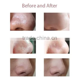 Micro Machine Facial Cleansing Portable Dermabrasion Machine for Blackhead Removal thumbnail-6