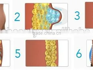 Fat Reduce Criolipolysis Fat Freezing Machine Cryotherapy Slimming thumbnail-4