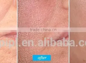 480-1200nm China Manufacturer Best Price Fractional Co2 Skin Redness Removal Renewing Laser Equipment Co2 Laser Scar Removal 1ms-5000ms thumbnail-4