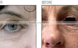 30W RF Tube Medical Laser New System Co2 Cutting & Fractional Co2 & VRL Vaginal Tightening Laser thumbnail-5