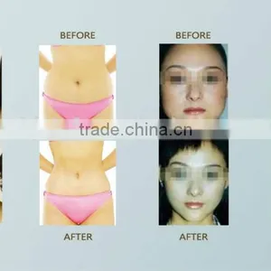 Cryolipolysis Weight Loss Machine thumbnail-4