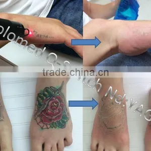 Beautician Use Nd Yag Laser Tattoo Removal Laser for Sale thumbnail-5