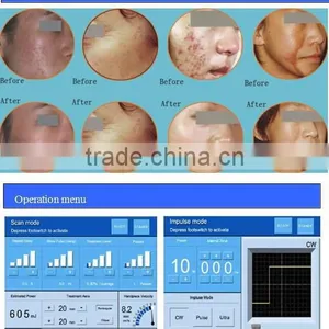 CO2 Fractional Laser ( RF Tube Made in USA )/ Fractional Co2 Laser Beauty Device thumbnail-6