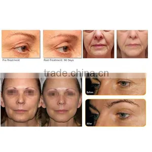 Portable High Frequency Face Machine Professional Face Lifting Machine Prices Hifu Fda Approval 0.1-2J thumbnail-5