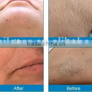 Professional Shr Ipl Hair Removal System Machine in Hot Sale thumbnail-5