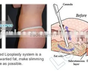 Surgical Liposuction PAL Liposuction With Liposuction Cannulas thumbnail-5