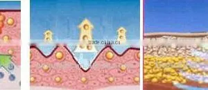 AYJ-T28 Dot Matrix RF Wrinkle Removal Machine thumbnail-5