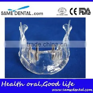 Hot Sale Transparant Mandibule Implant Model thumbnail-1