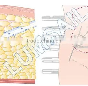 LUMSAIL Vaser Tumescent Liposuction Machine BS-LIPS5 thumbnail-5