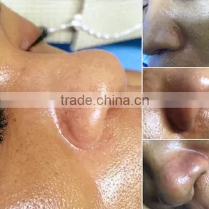 High Frequency  HIFU-C New Tech! HIFU Forehead Wrinkle Removal For Face Body Slimming Machine/liposunic Ultrasound Machine/cellulite thumbnail-2