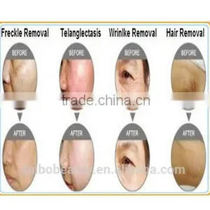 IPL Laser Longhair Short Hair Permanent Removal Beauty Equipment Aesthetic Alexandrite thumbnail-6