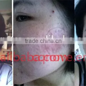2016 Blood Vessels Removal New Product Skin Care Led Facial Light Machine Oem Biofeedback LED Mask thumbnail-6