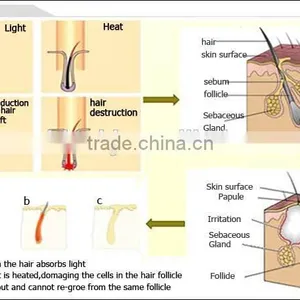 SHR Hair Freckle Removal Machine/OPT SHR IPL System/intense Pulse Light Hair Remover thumbnail-3
