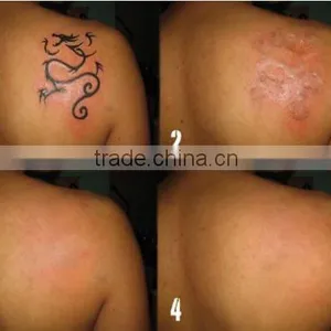 Tattoo Removal Laser Machine China Laser/Tattoo Removal Naevus Of Ito Removal Laser Beauty Device Brown Age Spots Removal thumbnail-6