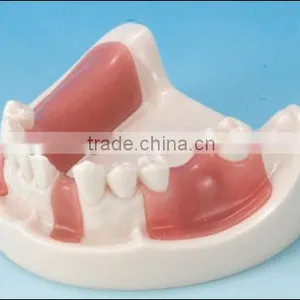 Dental Equipment Teaching Implant Tooth Model Standard Size Teeth Model thumbnail-2