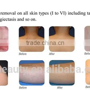 2016 High Technology 808 Laser Hair Removal Machine Portable thumbnail-4