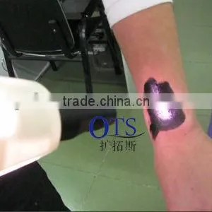 2015 Recently Designed Q-Switched ND Yag Laser for Tattoo Removal, Pigement Removal and Skin Rejuvenation thumbnail-2