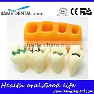 Pit and Fissure Model Dental Eduction Assistant No. DEA-19 thumbnail-1