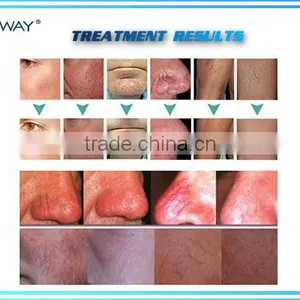 Immediately Result Varicose Veins Laser Treatment Diode Laser 980nm Spider Vein Removal Machine thumbnail-3
