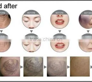 Professional Nd:yag Laser Tattoo Removal Device for Sale thumbnail-3