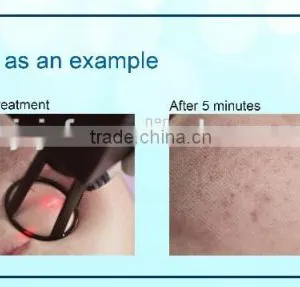F5 Best Selling 30W RF Tube Wrinkle Removal Laser CO2 Fractional thumbnail-5