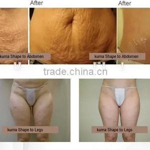 High Quality! Velashape Cavitation Negative Vacuum rf Roller Laser Clinical Equipment Ultrasonic Liposuction Belly Fat Removal thumbnail-6