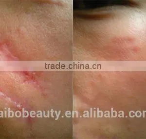 FDA Approved Beauty Equipment Scanning Co2 Fractional Laser Fractional CO2 Clean Laser Portable thumbnail-6