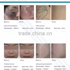 Q Switch ND YAG Laser For Colorized Tattoo Removal & 0.5HZ Pigmentation Removal/ Best Laser Tattoo Removal Machine Vascular Tumours Treatment thumbnail-4
