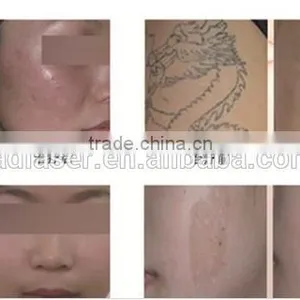 1064nm 1064 Nm 532 Nm Nd Yag 1 HZ Laser Alexandrite Laser Hair Removal Machine Price thumbnail-5