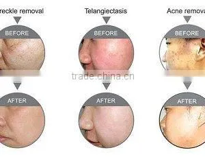 New Design Spa Use Ipl Laser Hair Removal Machine for Sale thumbnail-3