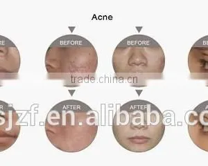 2016 Co2 Laser Scar Removal Equipment for Salon thumbnail-5