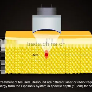 Slimming Machine Liposonix Hifu Machine thumbnail-6