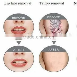 Q Switch Laser Machine Q-switched Nd Yag Laser Mole Removal Machine/ Tattoo 800mj Removal Laser Machine Nd Yag Laser/Laser Tattoo Removal Machine Haemangioma Treatment 532nm thumbnail-2
