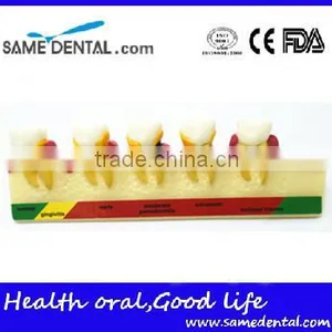 2x Periodontal Disease Classification Models Dental Eduction Assistant No. DEA-20 thumbnail-2