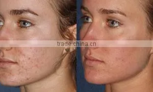 Vagina Cleaning Machine High Quality And Best Price Fractional C02 Vaginal Rejuvenation Laser Beauty Equipment Co2 Laser Scar Removal Acne Treatment thumbnail-5