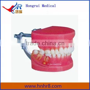 Dental Teeth Periodontal Disease Demonstration Teaching Model thumbnail-1