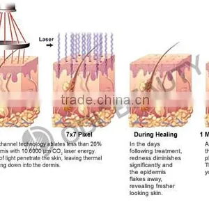 2015 New Arrival !! Fractional Co2 Laser Tech Vaginal Rejuvenation Feature OD-V8 thumbnail-4