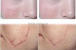 2015 Lowest Distributor Price: Sanhe Supercritical Co2 Extraction Machine for Acne Scars Treatment , Burn Debridement thumbnail-6