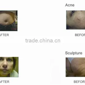 Apolomed RF Wrinkle Removal Skin Lift Beauty Equipment thumbnail-5