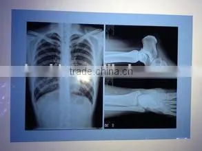 Dry Medical Thermal Dry Film KX410 X-ray Film Dry Film thumbnail-2