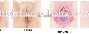 Eye Wrinkle / Bag Removal Popular Model F7+ Vaginal Fractional Rf Skin Resurfacing Co2 Fractional Laser Vaginal Tighten Machine thumbnail-6