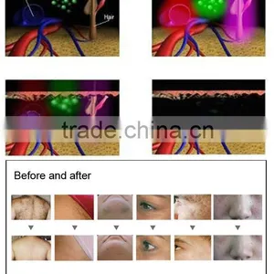 Ipl Laser Machine for Hair Loss thumbnail-3