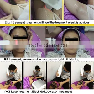 2016 High Quality Ipl Machine for Hair Laser Treatment rf Tattoo Removal Before and After thumbnail-6