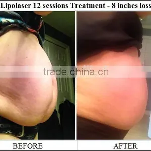 SUS 650nm Lipo Laser Fat Removal Machine/ Laser Slimming Machine thumbnail-6