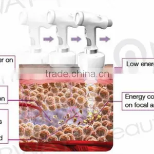 Beauty & Personal Care Best Liposonic Body Slimming Machine HIFU for Whole Body Sculpting Treatment thumbnail-2