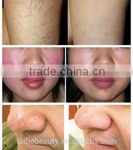 2016 The Professional Portable Varicose Veins Removal 980nm Laser Vascular Removal Beauty Equipment thumbnail-6