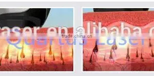 Excellent Alexandrite Laser /755 Hair Removal / Skin Refreshment Alex Laser Device thumbnail-2